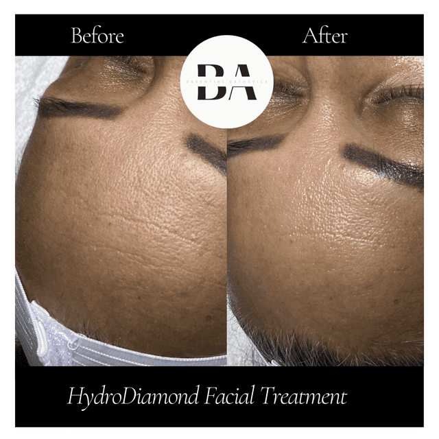 Hydro Diamond Series of 3 at BA Essential Esthetics in League City, TX